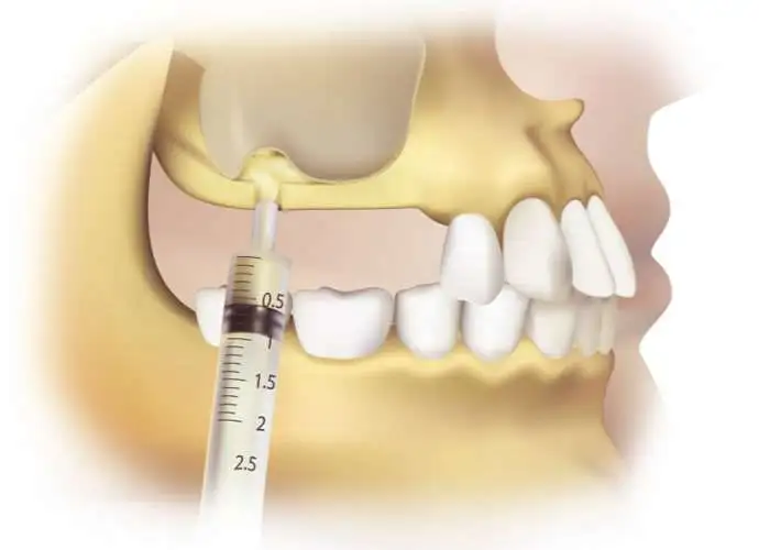 تزریق در دندان